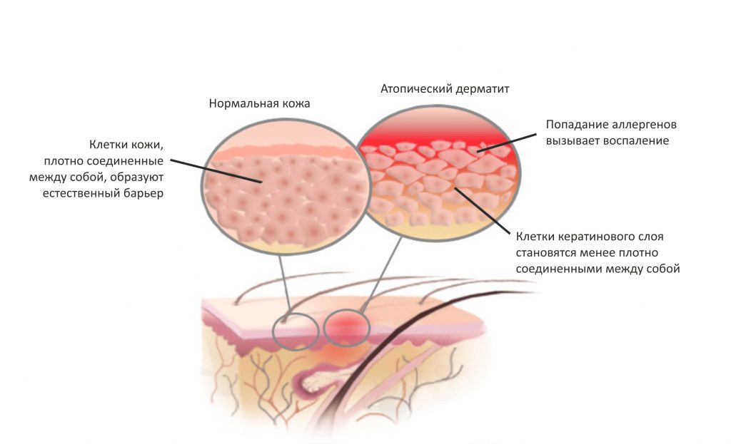Атопический дерматит