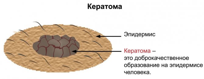 Старческий кератоз кожи как выглядит фото лечение