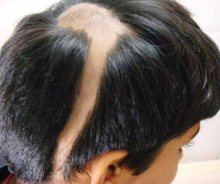 Алопеция гнездная